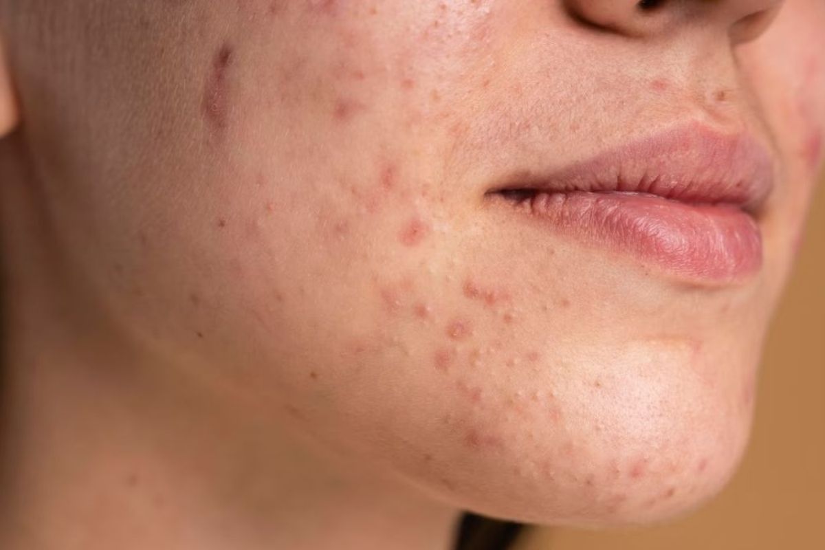Best Acne Treatment in Delhi NCR