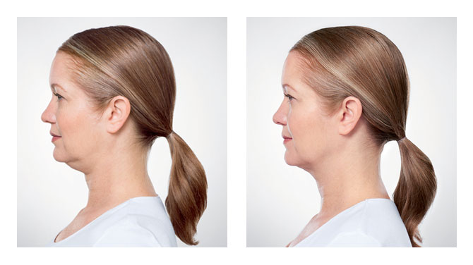 best Double Chin Reduction Service
